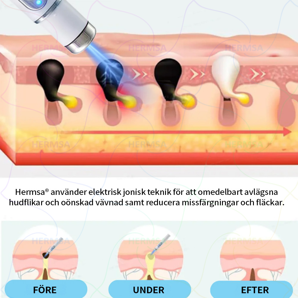 Hermsa® icke-invasiv laserpekare - borttagning av födelsemärken och vårtor
