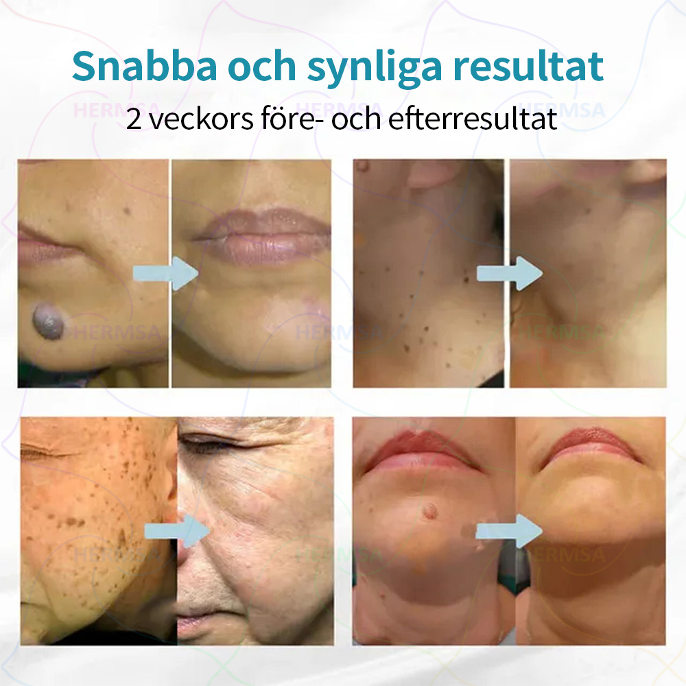 Hermsa® icke-invasiv laserpekare - borttagning av födelsemärken och vårtor