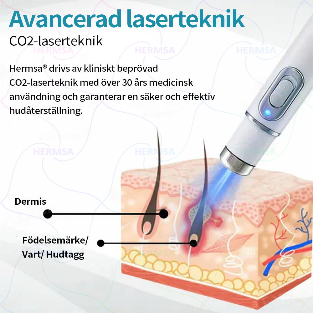 Hermsa® icke-invasiv laserpekare - borttagning av födelsemärken och vårtor